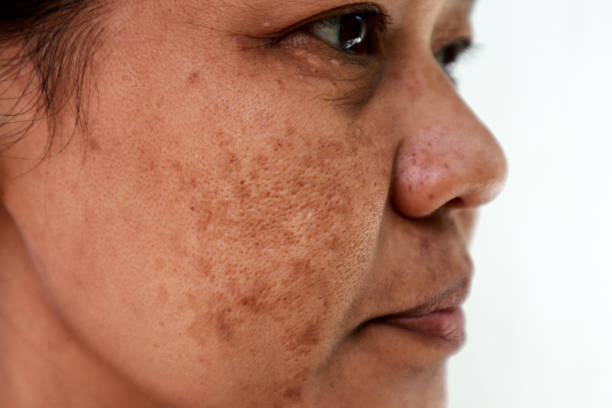 Microagulhamento Rosto melasma 1